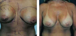 Breast Implant Revision Patient Before & After Photo 1