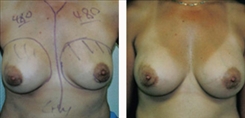 Breast Implant Revision Patient Before & After Photo 1