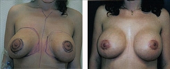 Breast Implant Revision Patient Before & After Photo 1