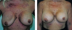 Breast Implant Revision Patient Before & After Photo 1