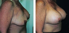 Breast Implant Revision Patient Before & After Photo 1