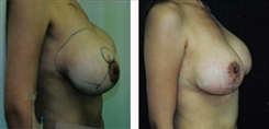 Breast Implant Revision Patient Before & After Photo 1