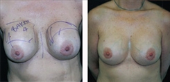 Breast Implant Revision Patient Before & After Photo 1