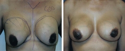 Breast Implant Revision Patient Before & After Photo 1