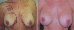 Breast Implant Revision Patient Before & After Photo 1