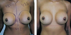 Breast Implant Revision Patient Before & After Photo 1