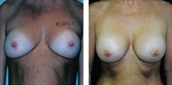 Breast Implant Revision Patient Before & After Photo 1