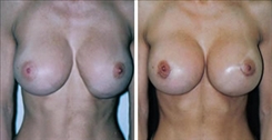 Breast Implant Revision Patient Before & After Photo 1