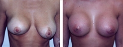 Breast Implant Revision Patient Before & After Photo 1