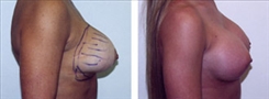 Breast Implant Revision Patient Before & After Photo 1