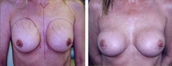 Breast Implant Revision Patient Before & After Photo 1