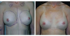 Breast Implant Revision Patient Before & After Photo 1