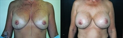 Breast Implant Revision Patient Before & After Photo 1