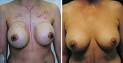 Breast Implant Revision Patient Before & After Photo 1