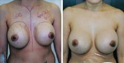 Breast Implant Revision Patient Before & After Photo 1