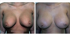 Breast Implant Revision Patient Before & After Photo 1