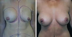 Breast Implant Revision Patient Before & After Photo 1