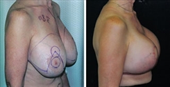 Breast Implant Revision Patient Before & After Photo 1