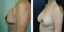 Breast Implant Revision Patient Before & After Photo 1