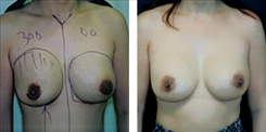 Breast Implant Revision Patient Before & After Photo 1