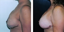 Breast Implant Revision Patient Before & After Photo 1