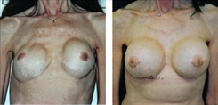 Breast Implant Revision Patient Before & After Photo 1