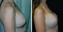 Breast Implant Revision Patient Before & After Photo 1