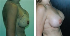 Breast Implant Revision Patient Before & After Photo 1