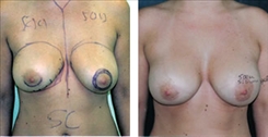 Breast Implant Revision Patient Before & After Photo 1