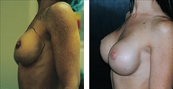 Breast Implant Revision Patient Before & After Photo 1