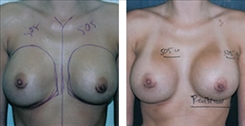 Breast Implant Revision Patient Before & After Photo 1