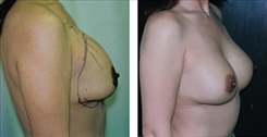 Breast Implant Revision Patient Before & After Photo 1