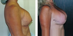 Breast Implant Revision Patient Before & After Photo 1