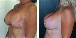 Breast Implant Revision Patient Before & After Photo 1