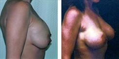 Breast Implant Revision Patient Before & After Photo 1