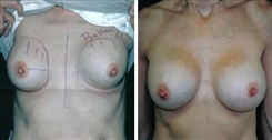 Breast Implant Revision Patient Before & After Photo 1