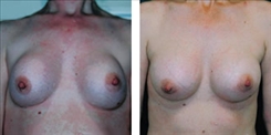 Breast Implant Revision Patient Before & After Photo 1