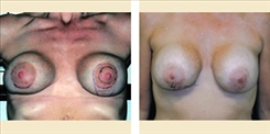 Breast Implant Revision Patient Before & After Photo 1