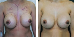 Breast Implant Revision Patient Before & After Photo 1