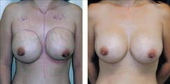 Breast Implant Revision Patient Before & After Photo 1