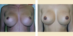 Breast Implant Revision Patient Before & After Photo 1