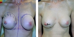 Breast Implant Revision Patient Before & After Photo 1