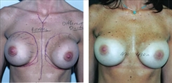 Breast Implant Revision Patient Before & After Photo 1