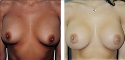 Breast Implant Revision Patient Before & After Photo 1