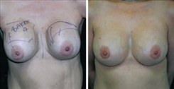 Breast Implant Revision Patient Before & After Photo 1