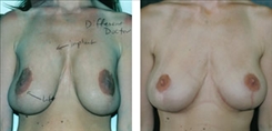 Breast Implant Revision Patient Before & After Photo 1