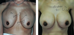 Breast Implant Revision Patient Before & After Photo 1