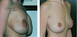 Breast Implant Revision Patient Before & After Photo 1