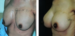 Breast Implant Revision Patient Before & After Photo 1