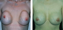 Breast Implant Revision Patient Before & After Photo 1